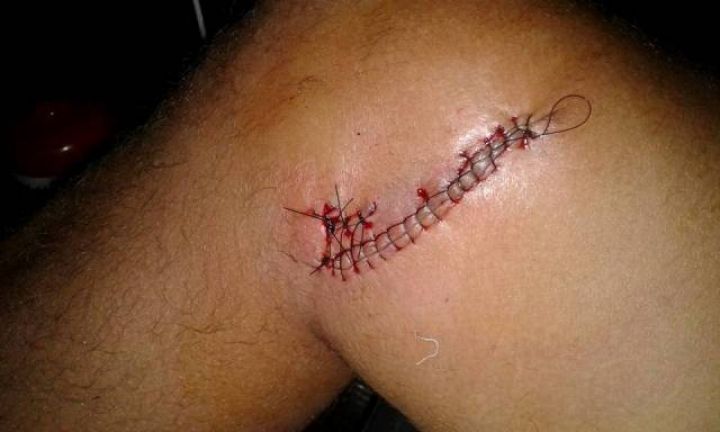 Caco de vidro fere coletor durante o trabalho