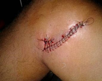 Caco de vidro fere coletor durante o trabalho